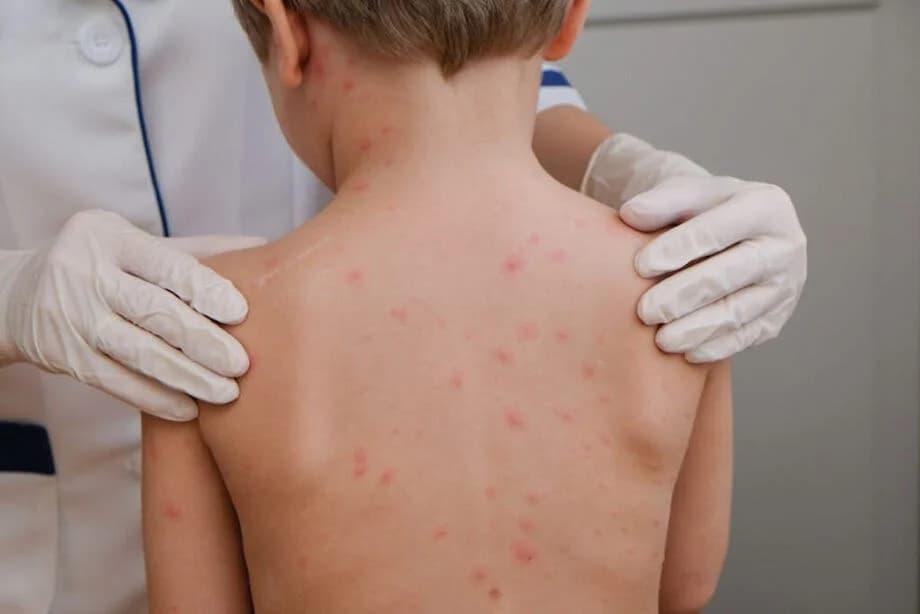 Aulas suspensas em Araputanga após confirmação de meningite