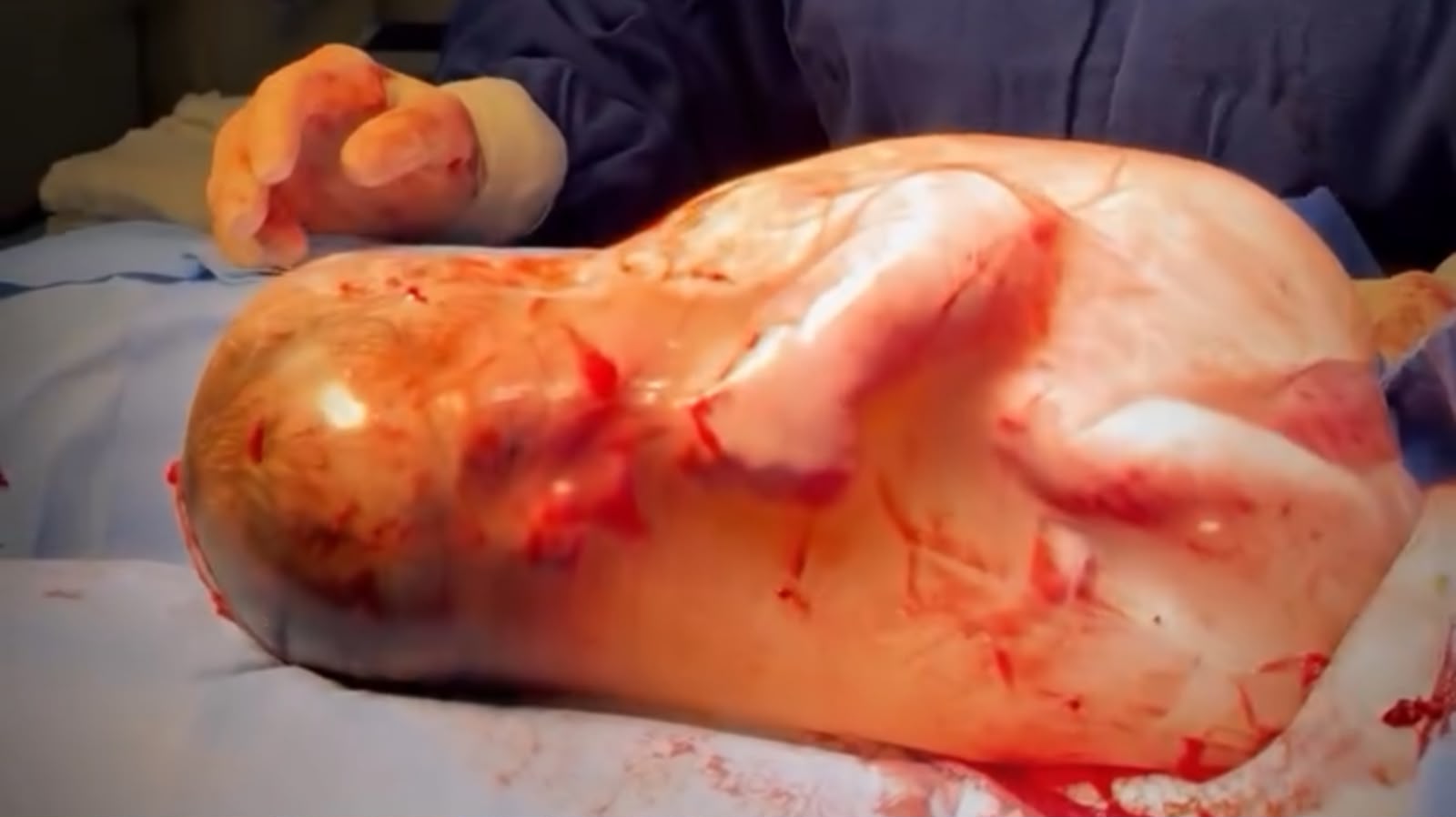 Bebê nasce dentro da bolsa amniótica em parto raro em Sorriso MT