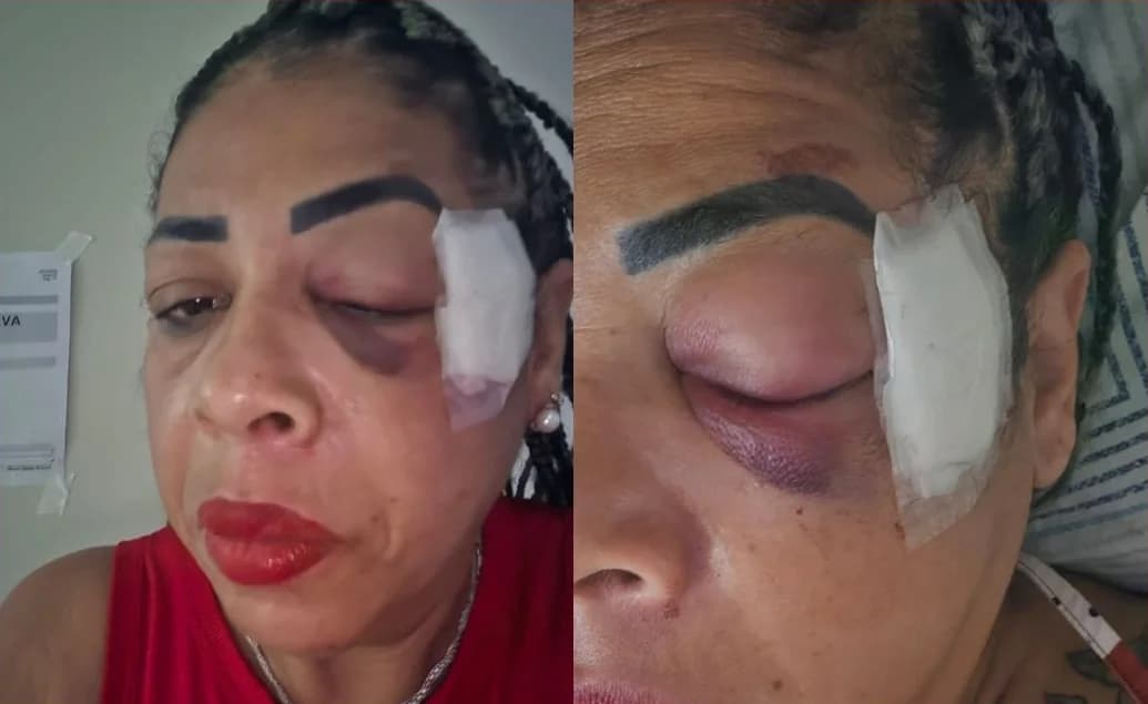 C Cáceres: servidora é atropelada em comemoração e sofre fraturas
