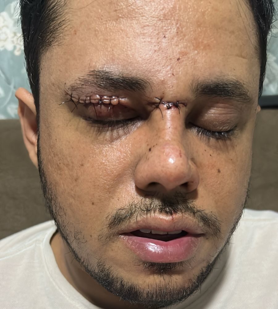 Linha com cerol deixa motociclista ferido em Primavera do Leste
