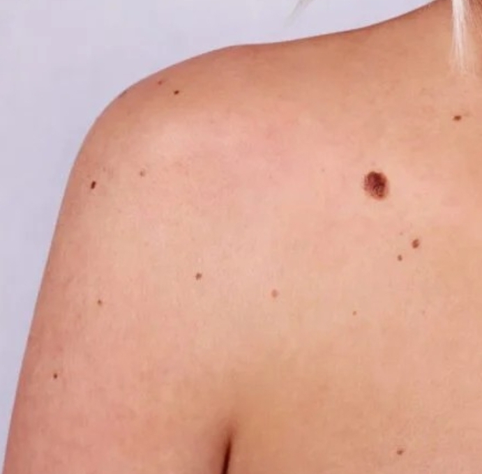 Mutirão de cirurgias reduz fila na dermatologia em Cáceres - Cidades